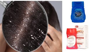 sir ki Khushi or dandruff ka ilaj Urdu handi Conaz lotion shampoo sulsun blue shampoo [upl. by Atekram]