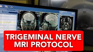 Trigeminal Nerve MRI scan protocol positioning and planning [upl. by Zeuqcaj]