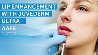 Adding More Lip Volume with Juvederm Ultra  AAFE [upl. by Bowman]