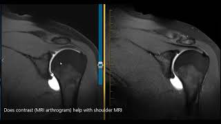 Does MRI arthrogram help see the labrum [upl. by Ashwell144]