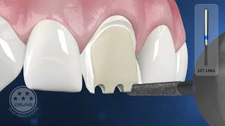 Metal ceramic restoration anterior teeth [upl. by Atilrac]