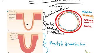 True and False Diverticula [upl. by Fletch]