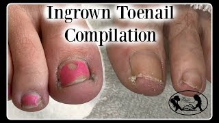 Satisfying Ingrown Toenail Pedicure Compilation [upl. by Canning783]