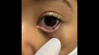 Conjunctival Cyst [upl. by Ahsiekim]