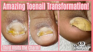 HOW TO GET RID OF TOENAIL FUNGUS AT HOME [upl. by Neibart]