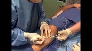 Ambulatory Phlebectomy Vein Removal  Skinovative and Center for Venous Disease [upl. by Airdnaid]