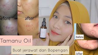 Review Tamanu Oil mengatasi jerawat dan Bopengan [upl. by Livvie]