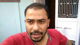 Adonsidil Finstrong 25X Minoxidil 7 months result After Hair Cutting  Kon kon se aur Medicine le [upl. by Audi]