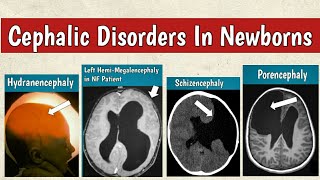 Cephalic Disorders In Newborns  Congenital Brain Malformations Radiology [upl. by Etteiluj]