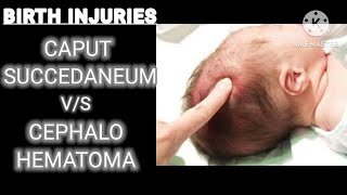 caput succedaneum VS cephalohematoma  AIIMS NORCET 5  ESIC  DSSSB  PGI  SGPGI  NURSING [upl. by Pellikka]