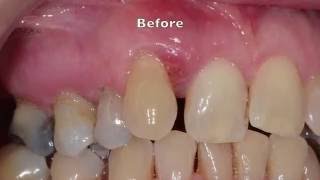 Treatment of Severe Gum Periodontal disease [upl. by Erb]