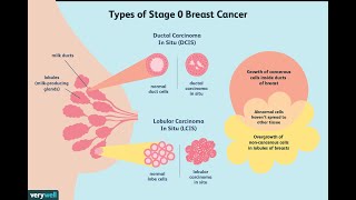 Treatment of Ductal Carcinoma in Situ [upl. by Mazman391]