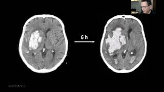 THE EANS WEBINAR INTRACEREBRAL HEMORRHAGE  NEUROSURGICAL TREATMENT PERSPECTIVES [upl. by Ahseikram]