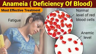 How to treat iron deficiency anemia  Anaemia treatment  Anaemia Diet  Anaemia Home remedies [upl. by Cyndi526]