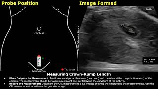 Step By Step Guide On 7 Week Pregnancy Transabdominal Ultrasound Scan  Full Protocol With Reporting [upl. by Eiltan133]