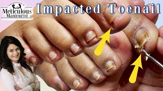 Twisting IMPACTED Toenails [upl. by Kola]