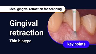 Thin biotype  Ideal gingival retraction for scanning [upl. by Roderick645]