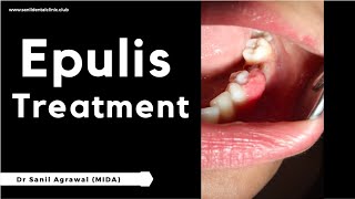 Gingival Enlargement  Epulis  Treatment  Dr Sanil Agrawal [upl. by Debora]