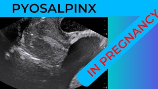 Pyosalpinx in pregnancy [upl. by Acinnej]