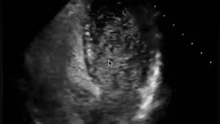 Bubble study on echo  PFO  The Echo Clip [upl. by Milson13]