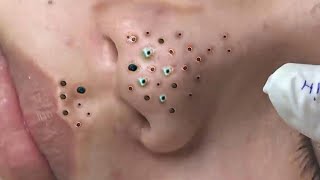 Big Cystic Acne Blackheads Extraction Blackheads amp Milia Whiteheads Removal Pimple Popping  1860 [upl. by Lowenstein]