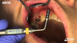 Astra Tech Implant System EV  Soft tissue measurement using Abutment Depth Gauge EV [upl. by Akeinahs212]