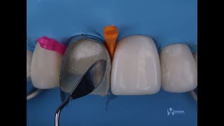 direct composite veneers with layering technique [upl. by Milford]