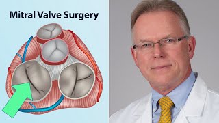 Mitral Valve Surgery What Should Patients Know Interview with Dr Vaughn Starnes [upl. by Free653]