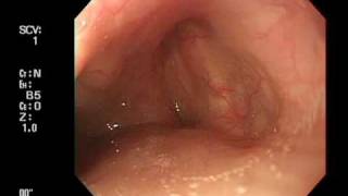 Endoscoe insertion from right pyriform sinus [upl. by Ramel155]