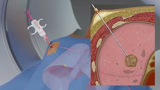 Lung Tumor Biopsy [upl. by Akenom]