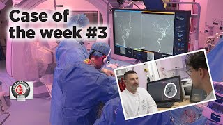 Case of the week 3  CTPerfusion and ADAPTQUATTRO for MeVO occlusions [upl. by Weidar425]