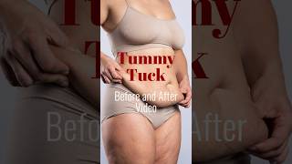 Amazing Tummy Tuck results at A Woman Plastic Surgeon® [upl. by Enelyahs]