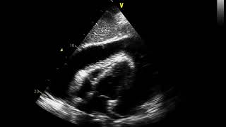 A Patient with Tuberculous Pericarditis [upl. by Lahey]