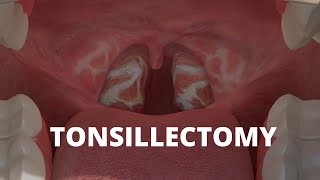 What is Tonsillectomy [upl. by Forland]