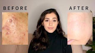 My Isotretinoin Accutane Journey  how I cleared my hormonal acne [upl. by Meid]