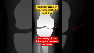 Joint space narrowing on Xray of knee with Osteoarthritis health radiology kneepain [upl. by Botti]