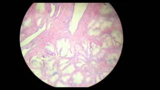 Benign prostatic hyperplasia histopathology [upl. by Aisercal]