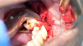 Extracted The Severely Abscessed Molar Tooth  Tooth Extraction [upl. by Jepum531]