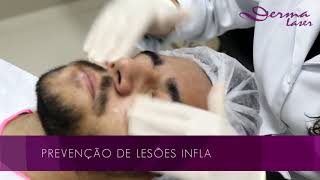 Limpeza de pele  Derma Laser [upl. by Nnairek50]