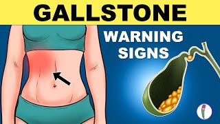 Gallbladder Stones Symptoms  Cholelithiasis  Gallstones Symptoms  Gallstones Warning Signs [upl. by Giguere]