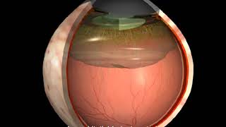Krankheiten des Auges Hintere Glaskörperabhebung [upl. by Oidiple]