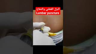 طريقة البزل القطني والنخاع lumbar puncture shorts [upl. by Aihsot]