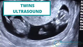 TAKE A PEEK Twins at 11 Weeks [upl. by Enetsirhc]