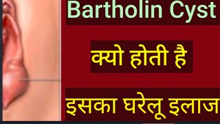 Bartholin cyst क्यो होती हैBartholin cyst home treatmentBartholincystkailaj [upl. by Aneelahs]