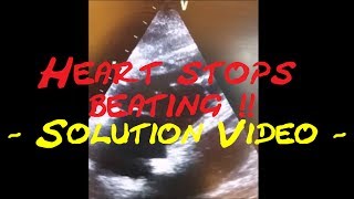 Cardiology Echo QuizCase Heart stops beating Part 2 Solution video [upl. by Breech]