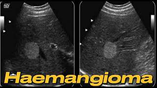 USGof hemongioma Hemongioma কি  এর কারণ ও প্রতিকার । [upl. by Geordie]