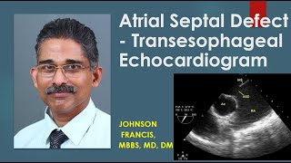 Atrial Septal Defect  Transesophageal Echocardiogram [upl. by Lemmueu]