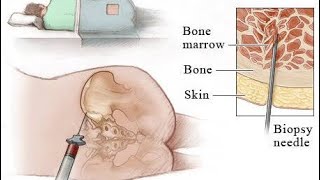 Interpretation of Bone marrow aspiration and Trephine biopsy [upl. by Joost]