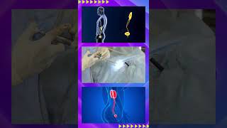 A visual journey through nephrectomy Our video simplifies the complexities of this surgery [upl. by Siladnerb]