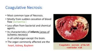 Necrosis  Pathology Necrosis ppt  Easy Explanation  types ampCauses  NEET PG  Hindi [upl. by Ettie]